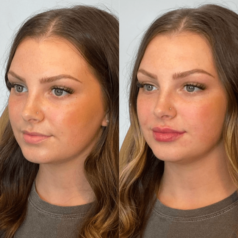How Much Do Lip Fillers Usually Cost